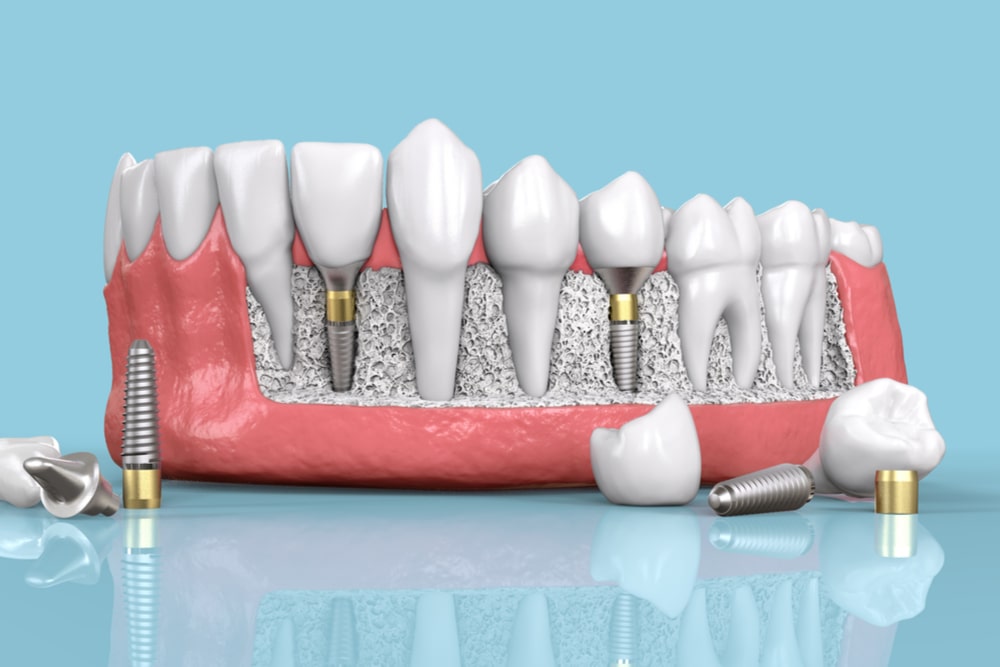 tooth dental implant model 3d illustration